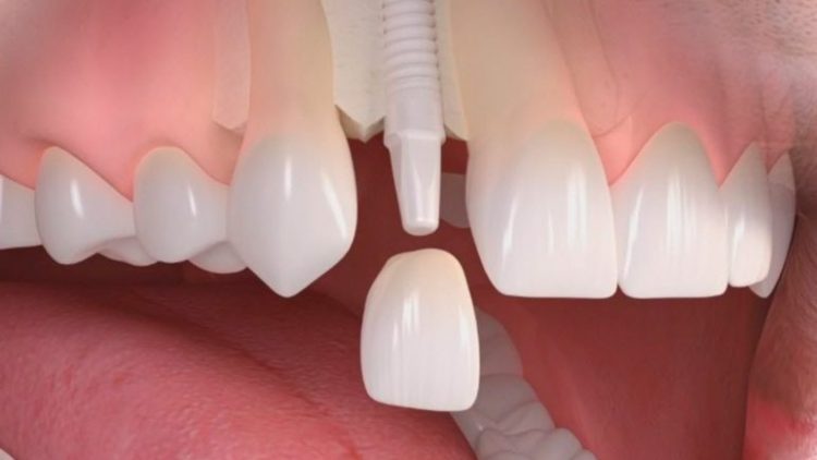 Первый отечественный керамический имплант зуба запатентовали в Кабардино-Балкарии