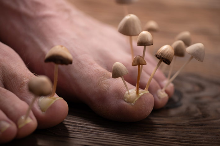 6 способов безопасного лечения грибка на ногах в домашних условиях - GlobalFashion