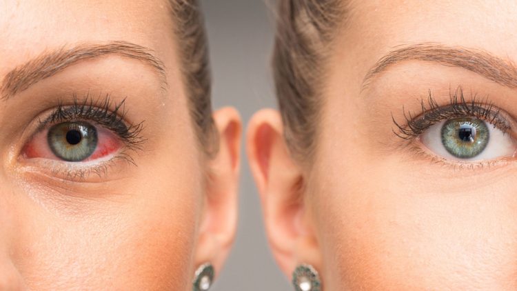 Росздравнадзор заверил пациентов в наличии глазных капель от аллергии в аптеках