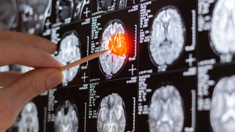 Ученые в Перми предложили новый способ диагностики болезни Альцгеймера