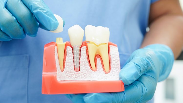 В Сеченовском университете создали зубные импланты, которые лучше приживаются
