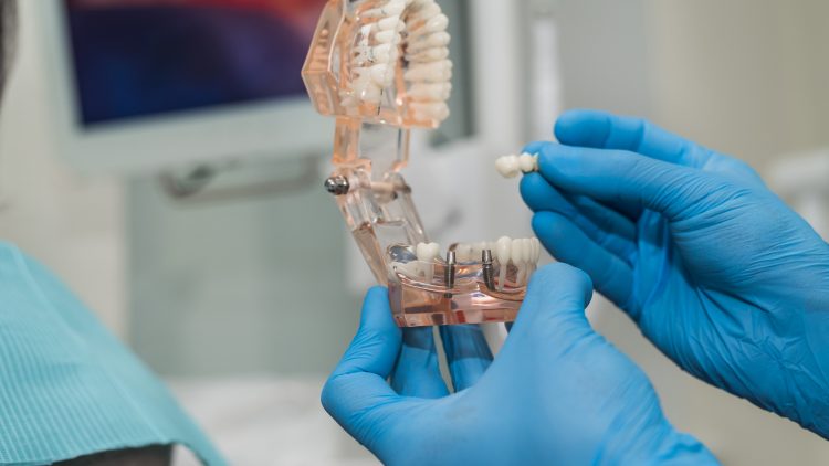 В России создали первую систему для проверки качества зубных имплантов