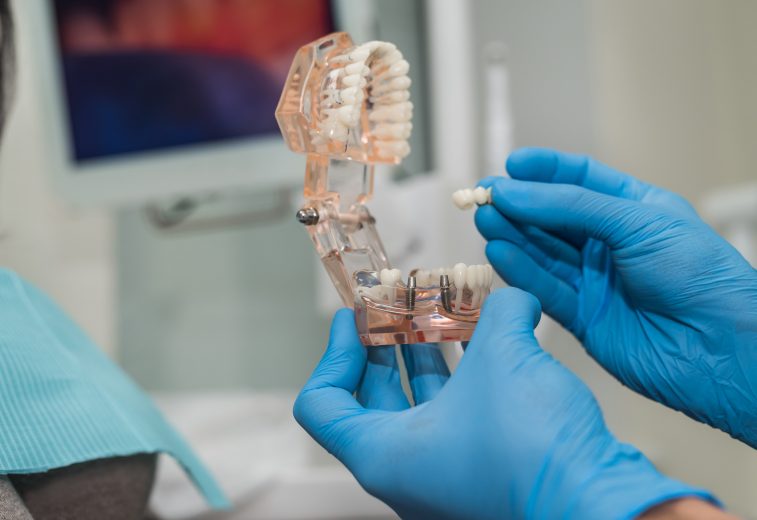 В России создали первую систему для проверки качества зубных имплантов