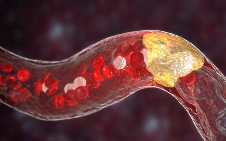 «Хороший» холестерин может быть не таким уж хорошим