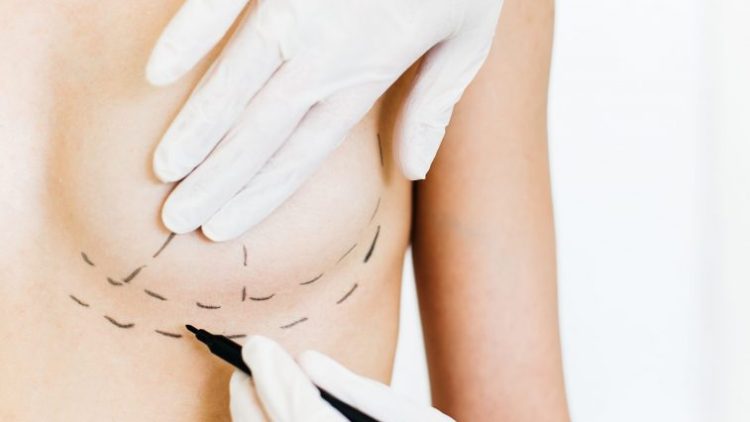 Россия попала в пятерку стран по числу исков из-за неудачной пластики груди